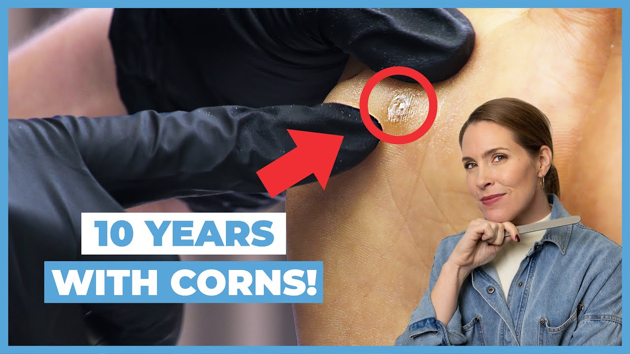Say Goodbye to Foot Pain with This Simple Solution | Corn Removal