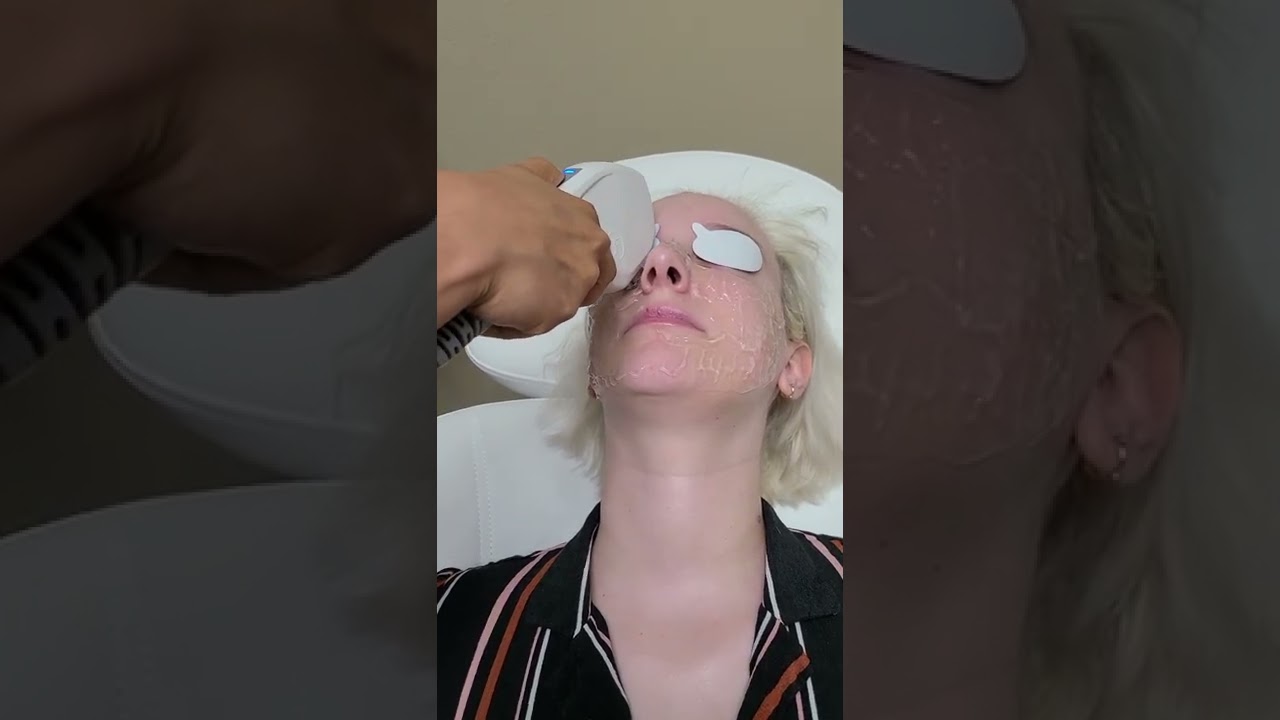 IPL (Intense Pulse Light) Treatment with FormaTK