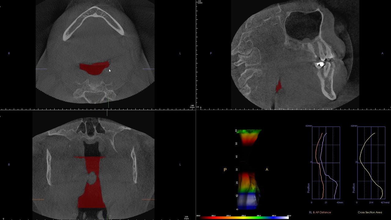 Upper Airway Analysis in CBCT. Obstructive Sleep Apnea (OSA) ??