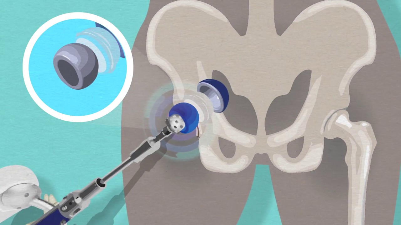 All You Need To Know About Robotic Assisted Total Hip Replacement