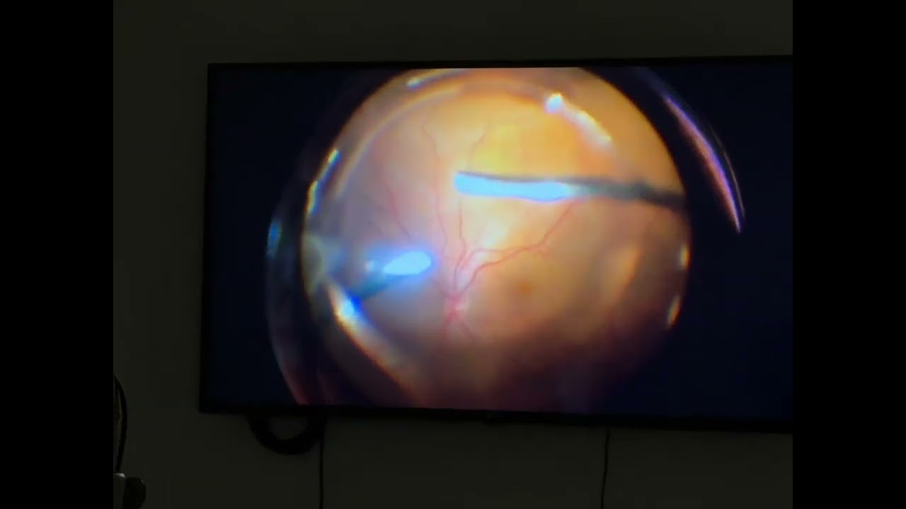 Vitrektomi për shkëputje retinale regmatogjene me çarje 180° – me sukses në Indian Eye Institute!