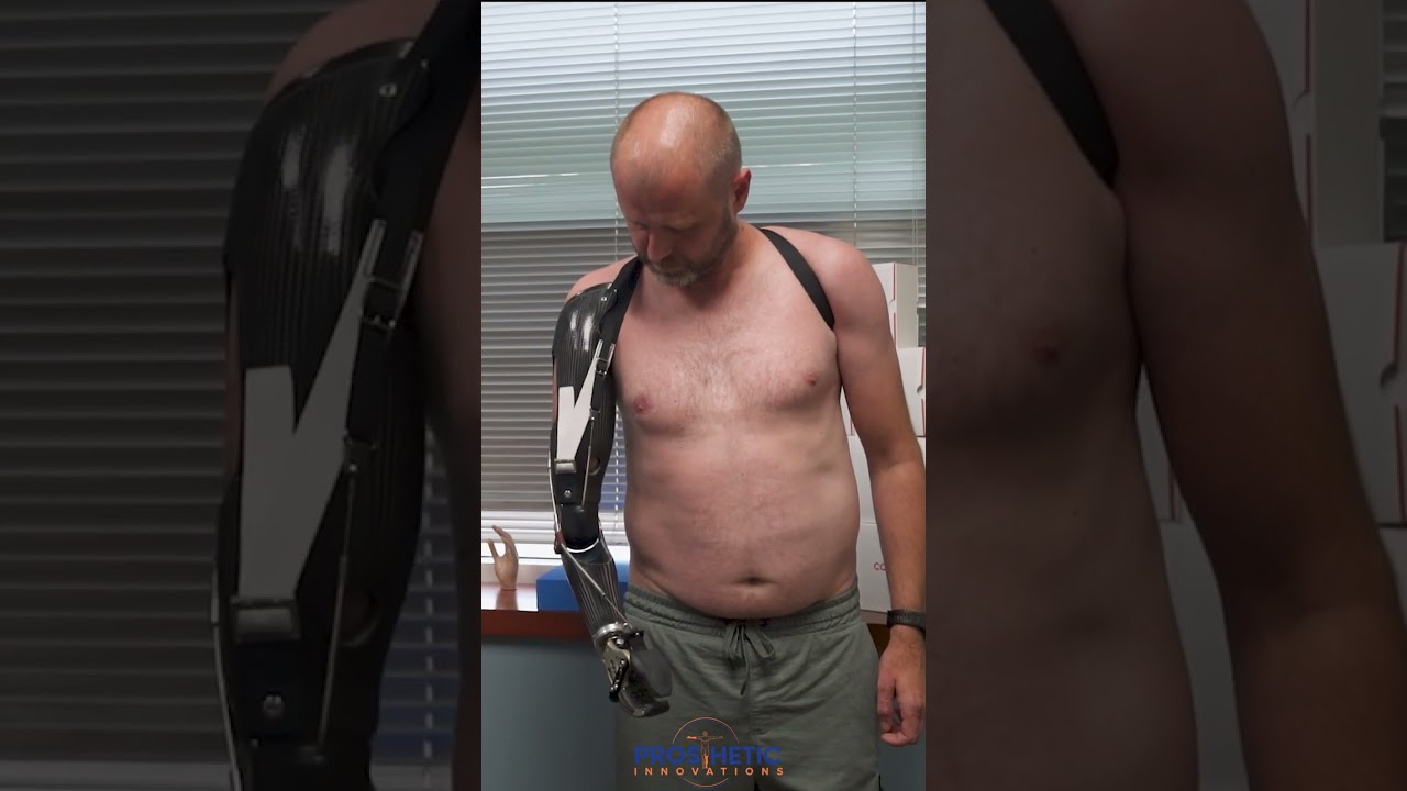 Trans-Humeral Ukrainian Soldier Body Powered Prosthesis | Prosthetic Innovations