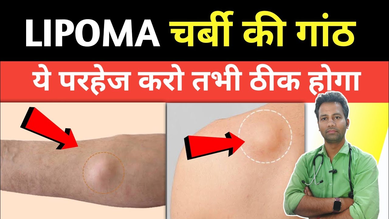 lipoma me parhej | लिपोमा में क्या नहीं खाना चाहिए ? Lipoma treatment |  Dr tarun
