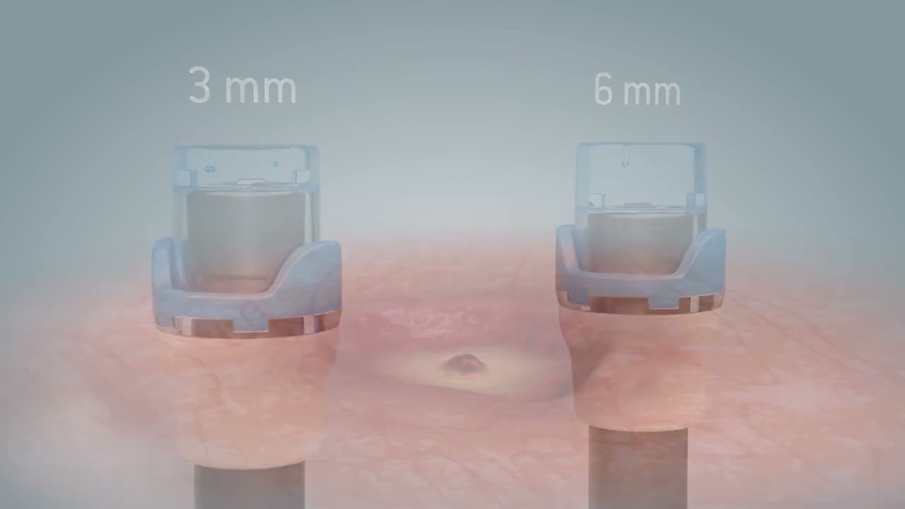 OTSC&reg;neo Haemostasis
