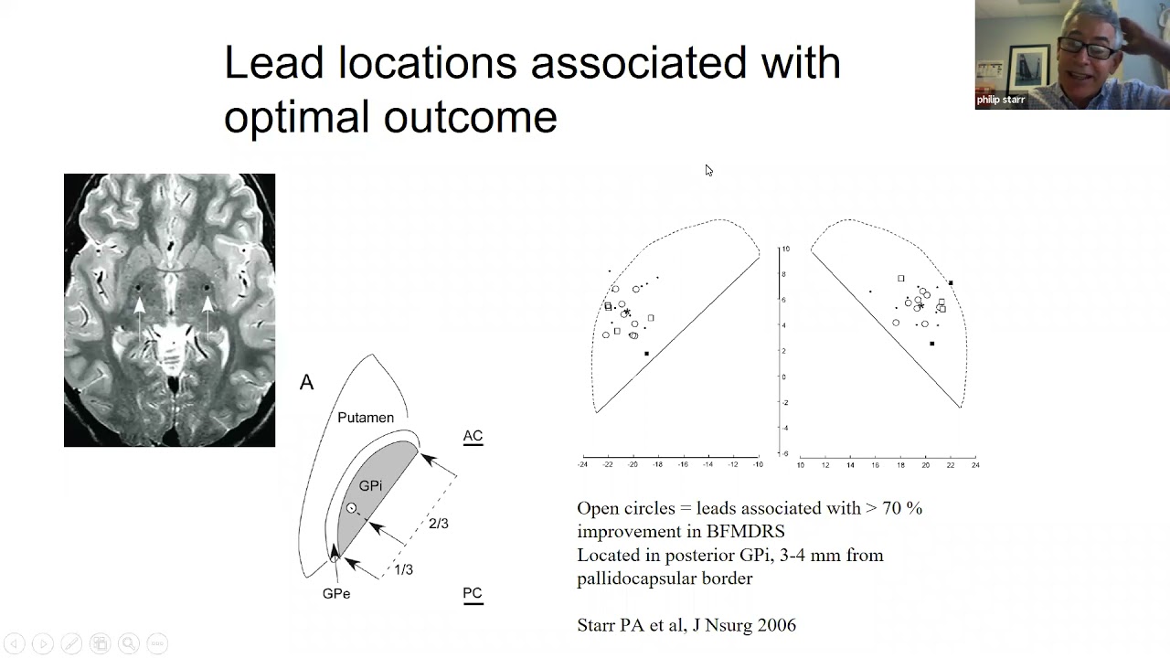 Brain Sensing & Adaptive Deep Brain Stimulation: Potential for Dystonia