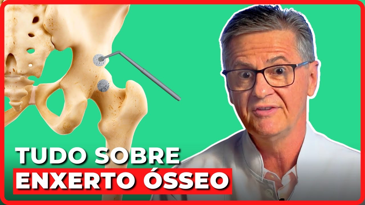 TIRANDO TODAS AS DÚVIDAS SOBRE ENXERTO ÓSSEO | Simplificando Ortopedia