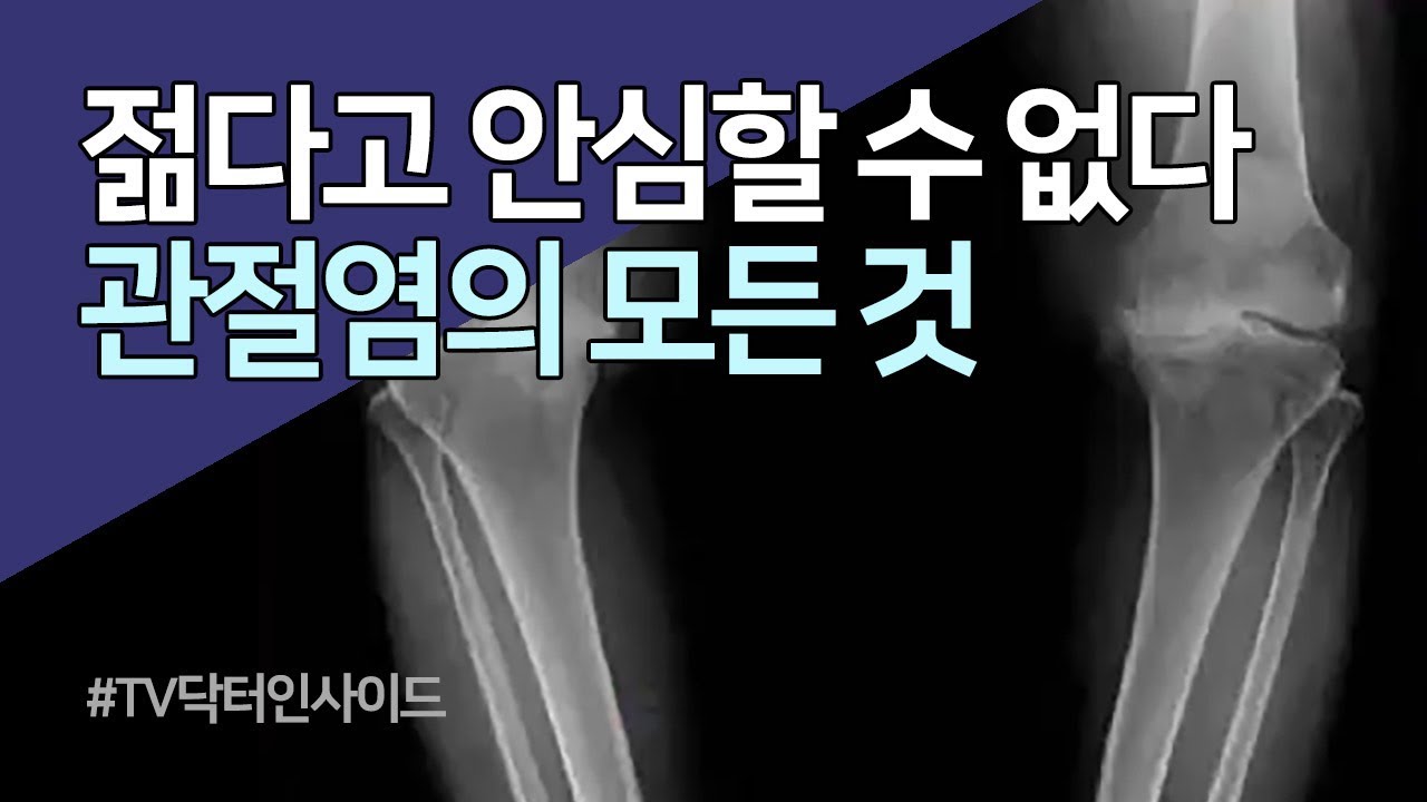 [TV 닥터 인사이드] 관절염의 모든 것