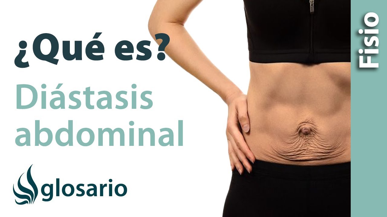 DIÁSTASIS ABDOMINAL | ¿Qué es?