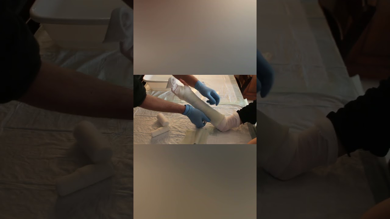 Doccia gessata in vetroresina per il polso  #prontosoccorso  #traumatologia  #trauma #ortopedia