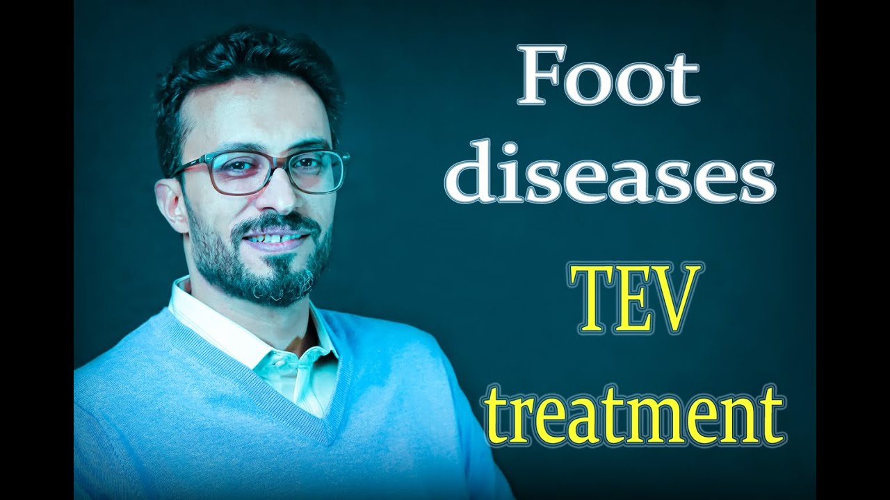 04 Foot diseases: TEV treatment