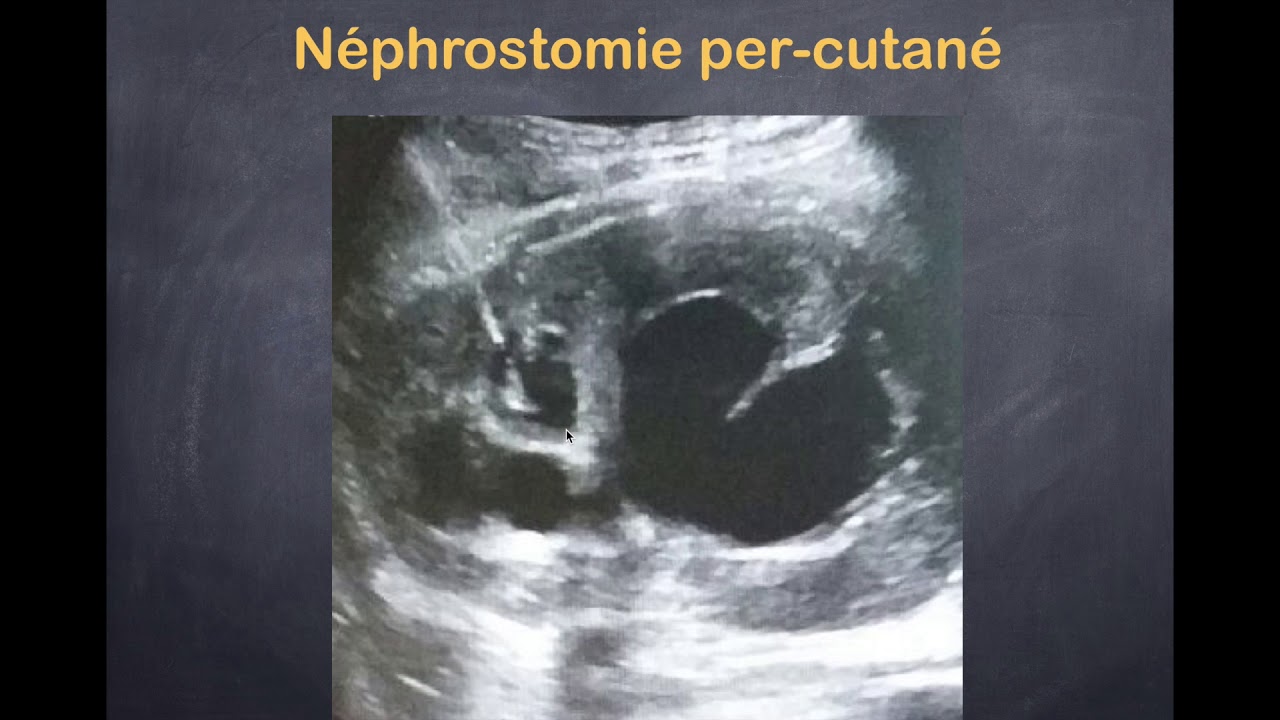 Infections urinaires - 5. Pyélonéphrite aiguë - Radiologie Interventionnelle