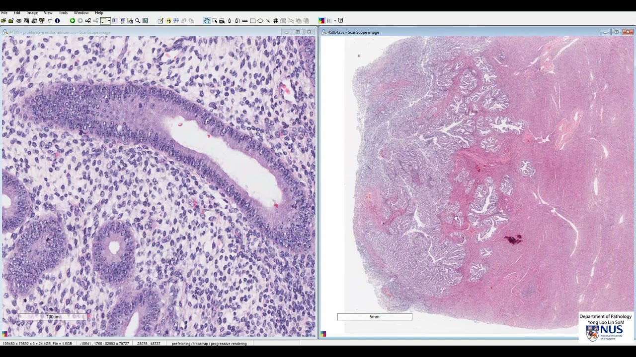 Uterus: Endometrial carcinoma Microscopy - Talking Slide