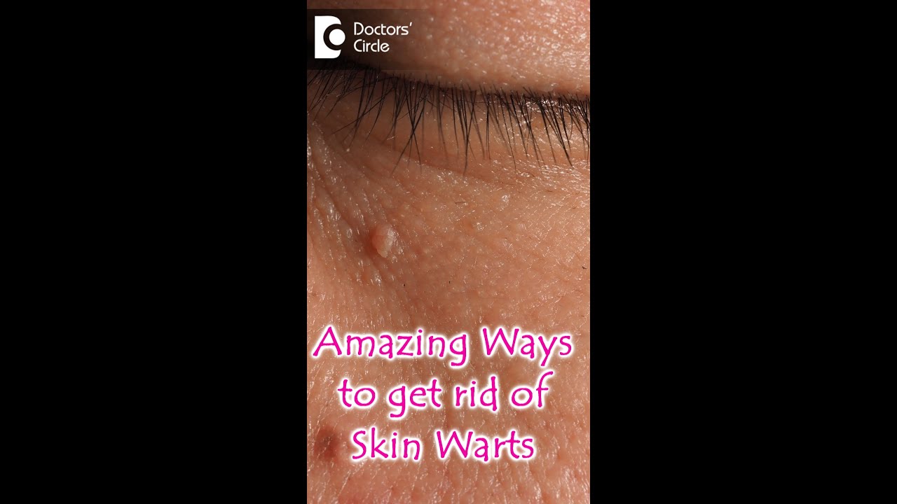 Amazing Ways to get rid of Skin Warts- Dr. Nischal K | Doctors' Circle #youtubeshorts #shorts
