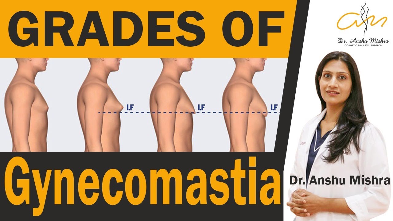 Man Boobs 💹Grades of Gynecomastia and Their Treatment | 💹Enlarged Breasts in Men - Dr. Anshu Mishra