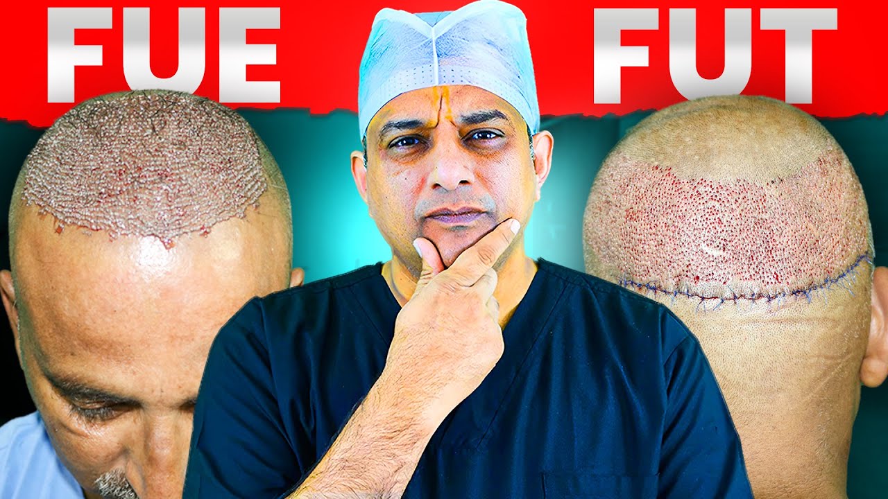 FUE vs FUT Hair Transplant | FUE Hair Transplant 2024 | Hair Transplant | Saraswat Hospital