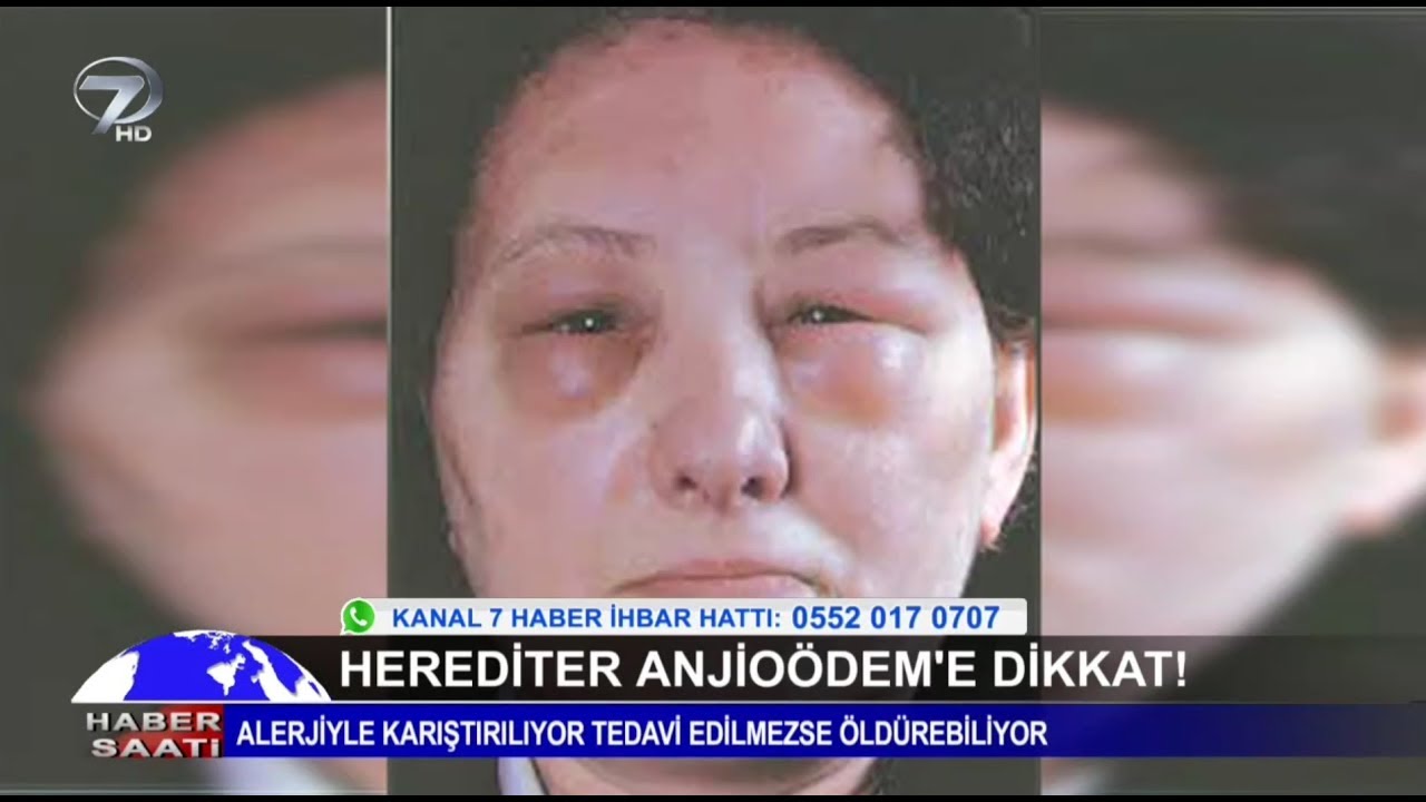 Herediter Anjioödem'e Dikkat!
