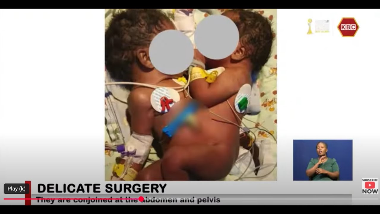Kenyatta National Hospital is currently managing a set of conjoined twins