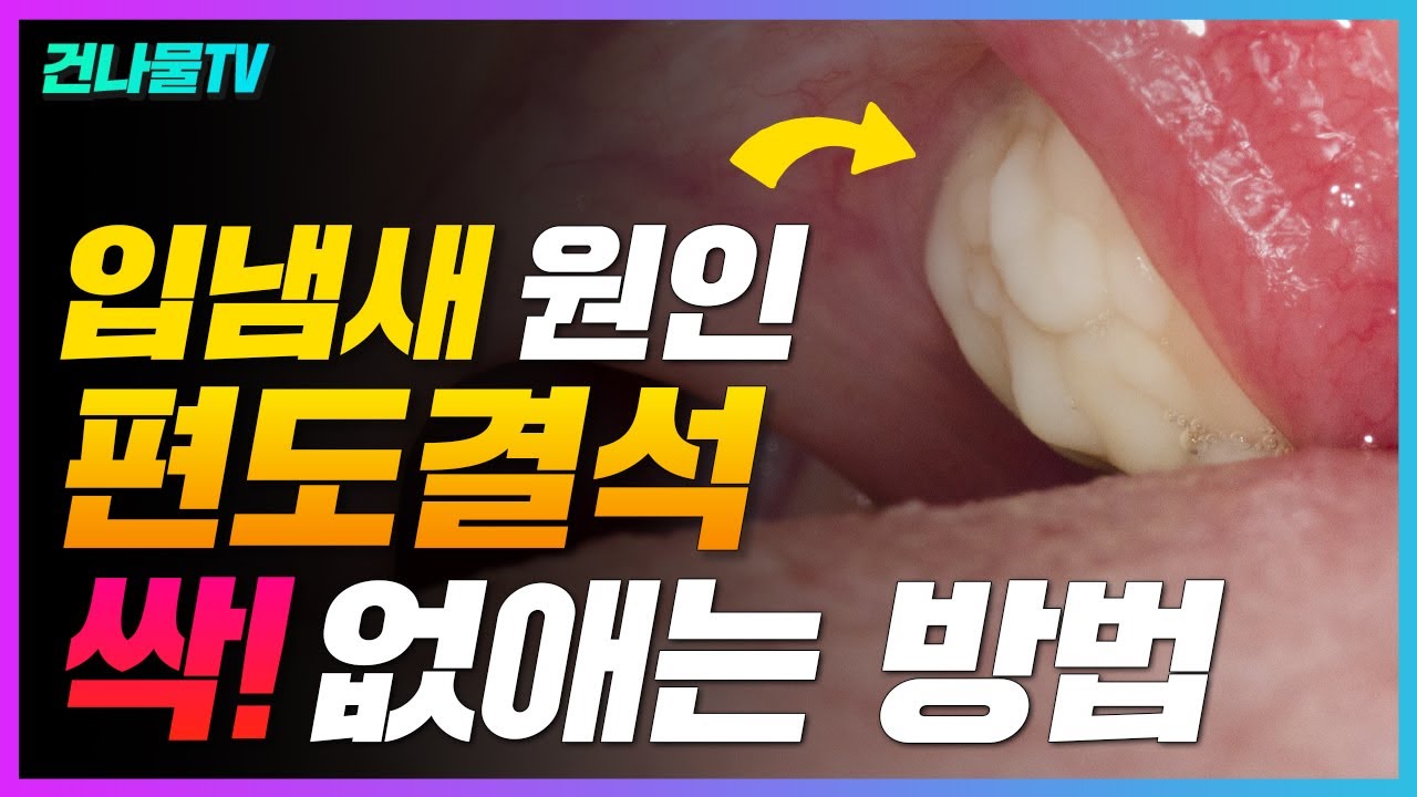 입냄새 쉽게 잡는 방법! 편도결석 없애는 방법 알려 드릴게요