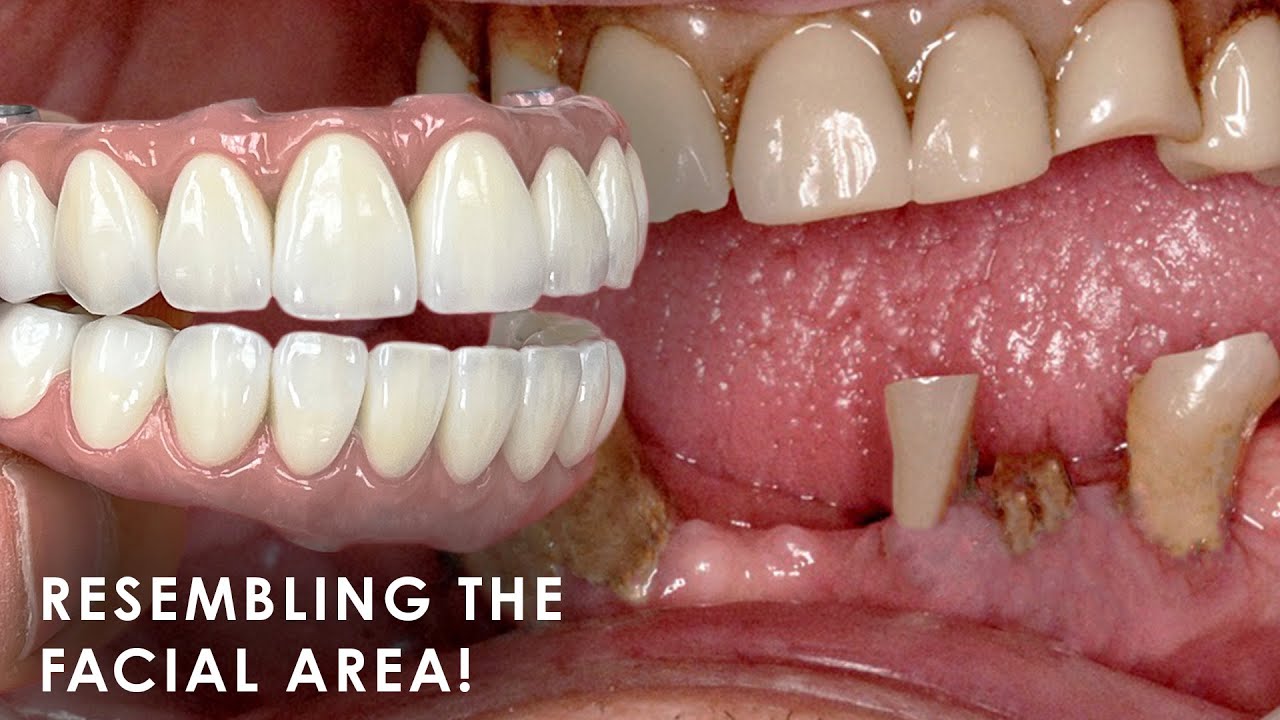 Creating Facial-Like Natural Teeth for Full Mouth Implants