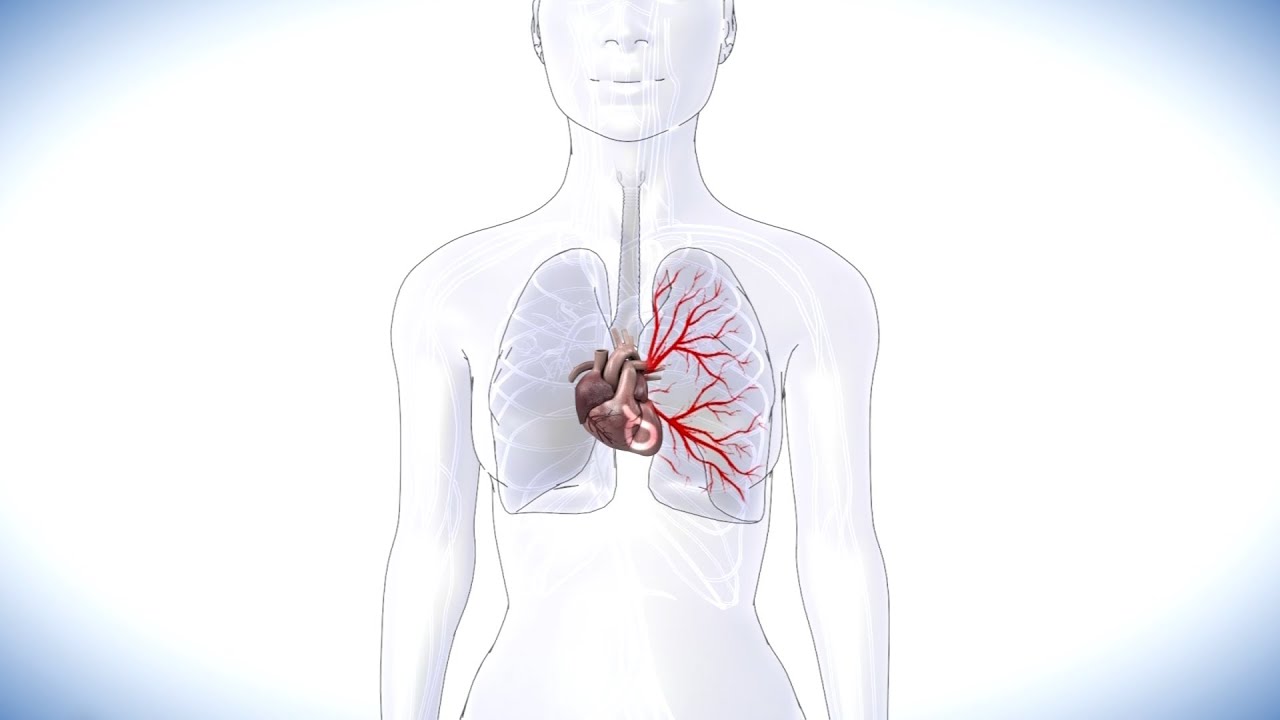 Consulta con Dr. Juan: ¿Cuáles son los síntomas de la hipertensión pulmonar? -- Exclusivo Online