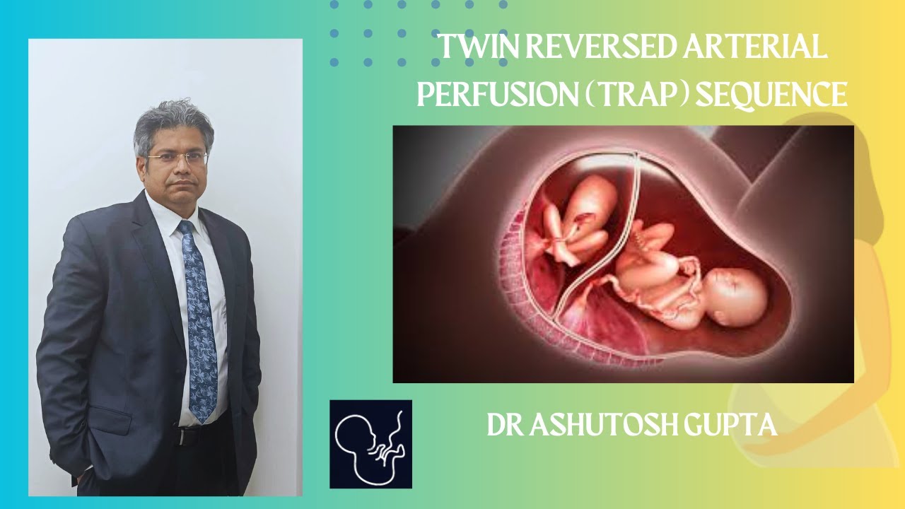 Twin reversed arterial perfusion (TRAP) sequence