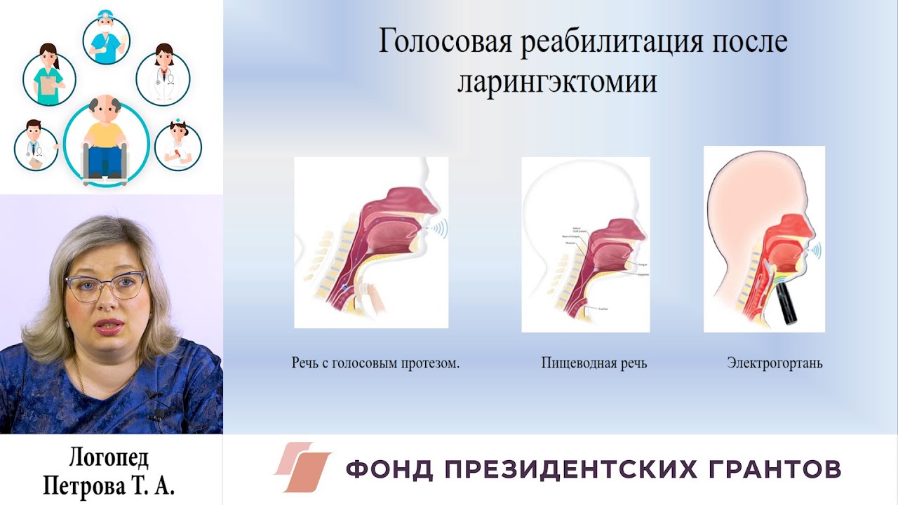 Восстановление голоса у онкологических пациентов перенёсших ларингэктомию