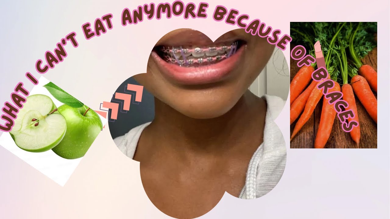 Foods I Stopped Eating After Getting Braces 😭 | My Experienc
