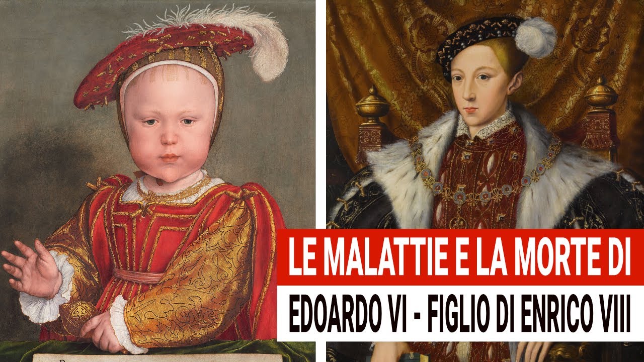 Le malattie di Edoardo VI: Re d'Inghilterra figlio di Enrico VIII