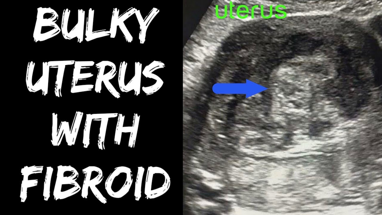 Bulky Uterus with Fibroid