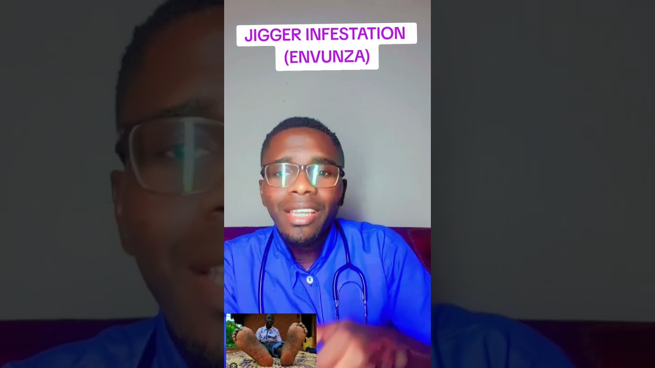 PREVENTION  OF JIGGER INFESTATION (TUNGIASIS)