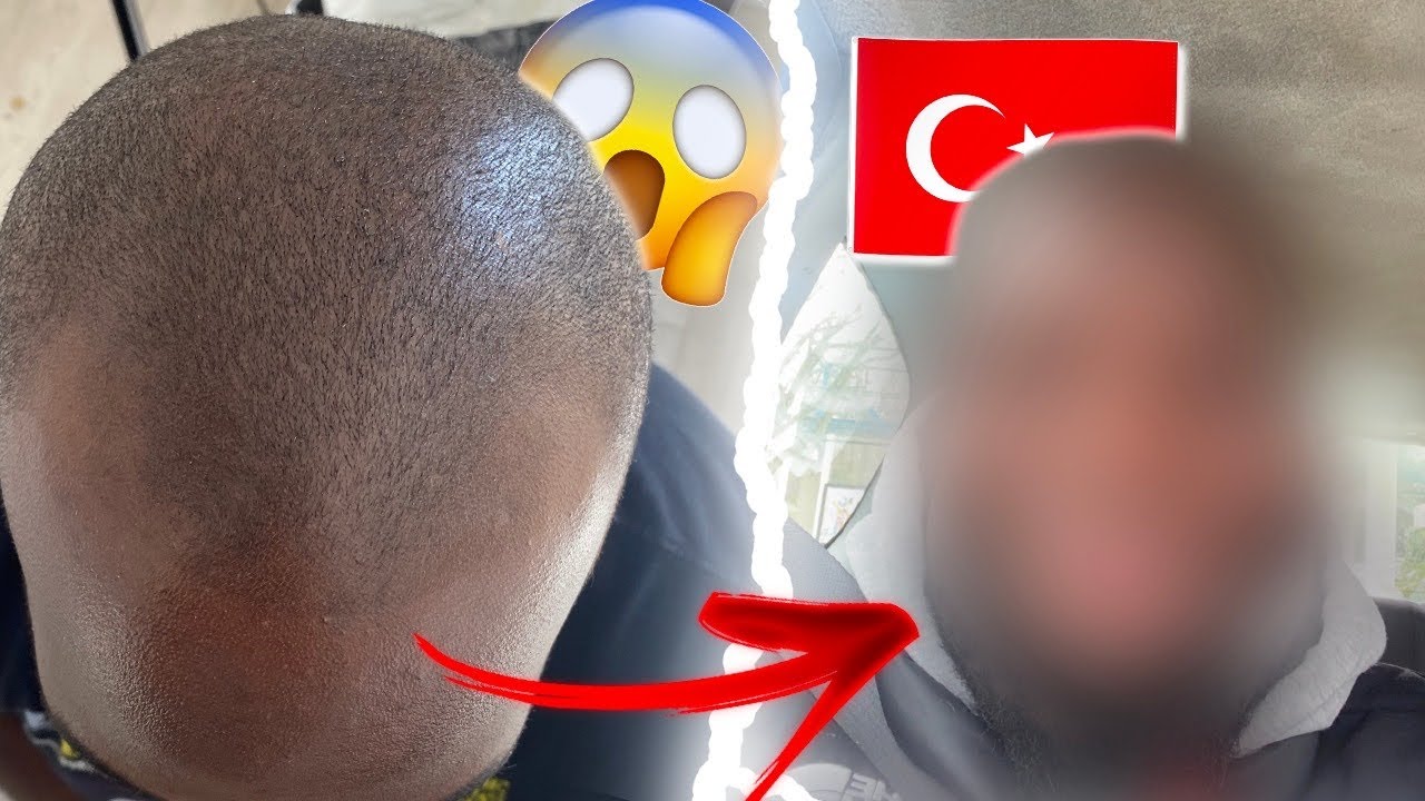 EVOLUTION DE MA GREFFE CAPPILAIRE ! (c'est incroyable)