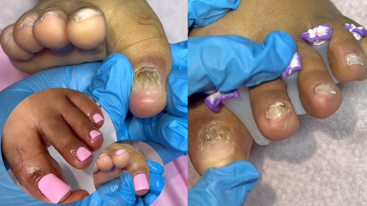 Acrylic on damaged toes | Toenails reconstruction | Toe nail transformation | Toe nail repair