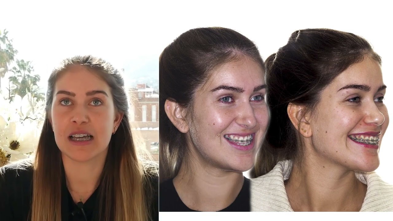 Jaw surgery Case# 126: Laura- Class III, Maxillary hypoplasia, Long face