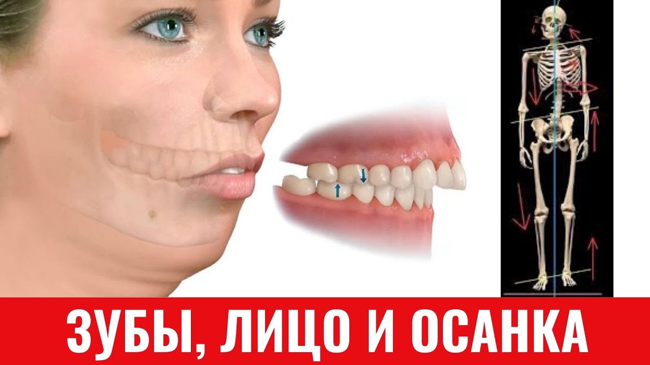 Зубы и их влияние на лицо и осанку. ТРАНСЛЯЦИЯ.