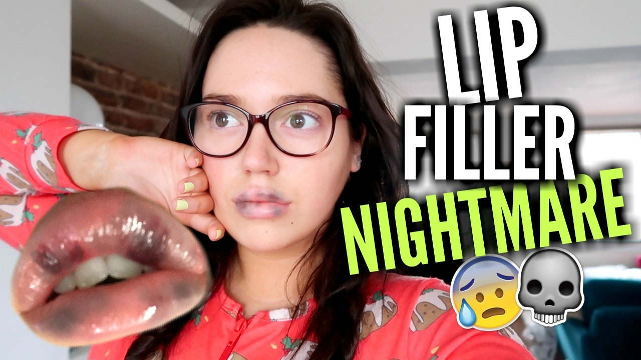 STORYTIME : My Lip Filler NIGHTMARE! 💉