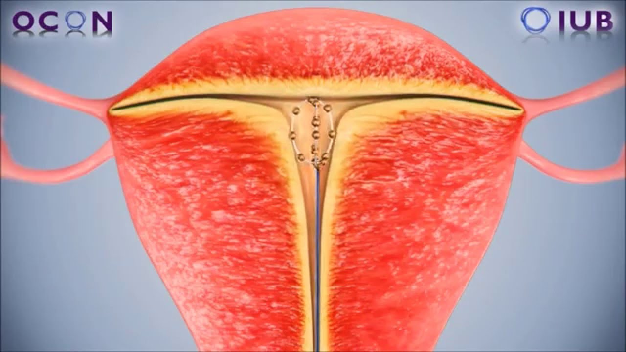The IUB SCu300 - a new spherical intrauterine device