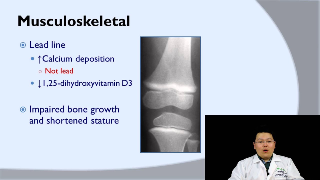 Lead Poisoning Lecture
