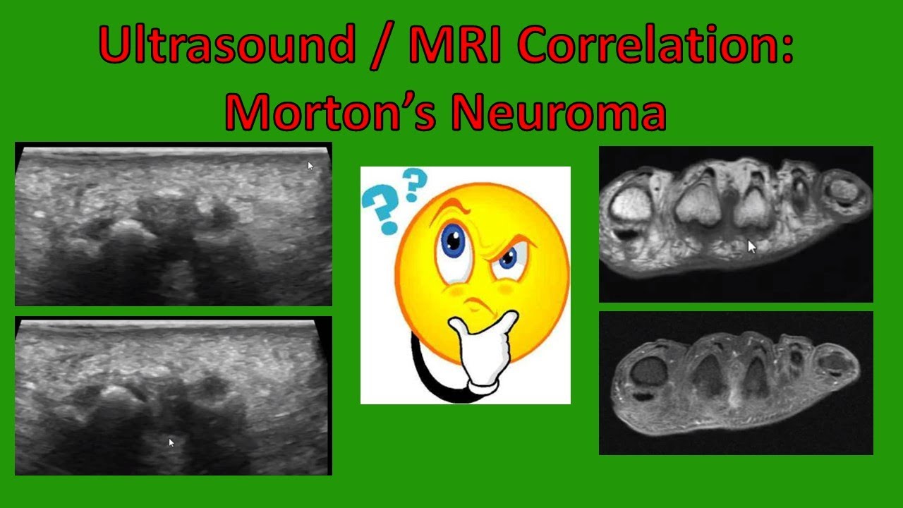 Ultrasound / MRI Mass Correlation: Morton's Neuroma (updated 2020)