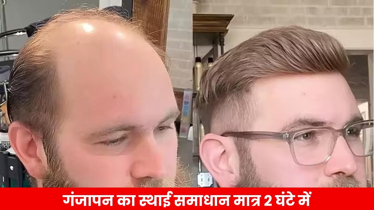 Hair Wig | Patch in Patna | Wig for Men in Patna 