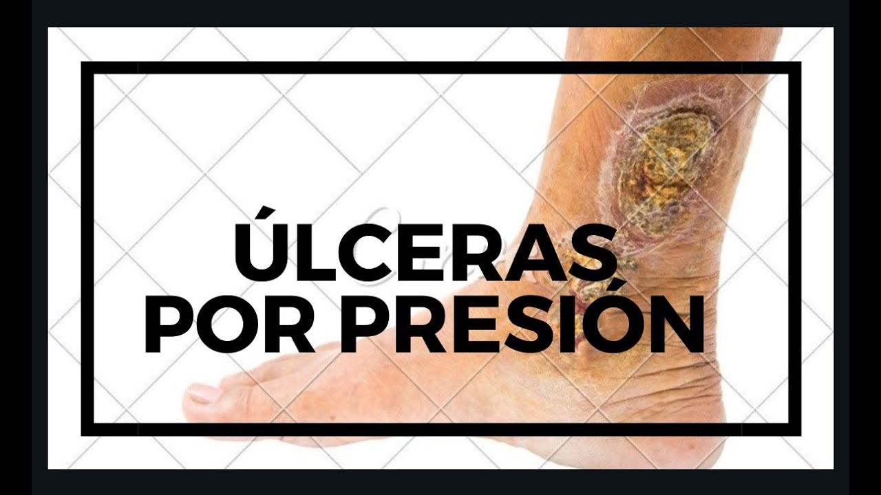 ÚLCERAS por PRESIÓN | UPP | ESCALA DE NORTON | ESCALA DE BRADEN | NORTON MODIFICADA | PODCAST | TCAE