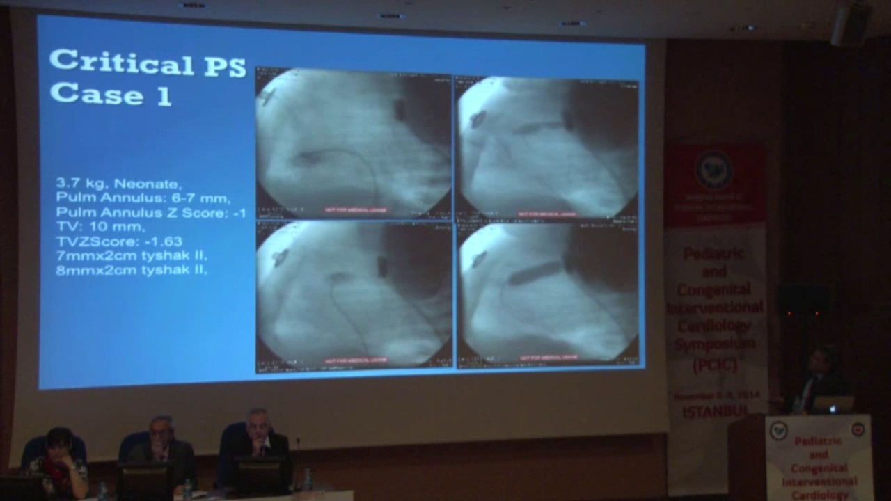 Tevfik Karagöz- Balloon valvuloplasty in critical pulmonary stenosis
