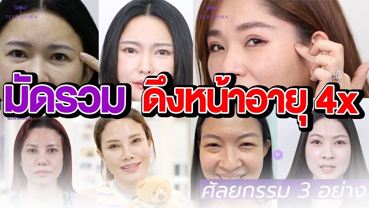 รีวิวดึงหน้า เคสดึงหน้า อายุ 40 ปีขึ้นไป ด้วยเทคนิค FACE-LOCK™ เฉพาะที่ธีรพรคลินิกเท่านั้น
