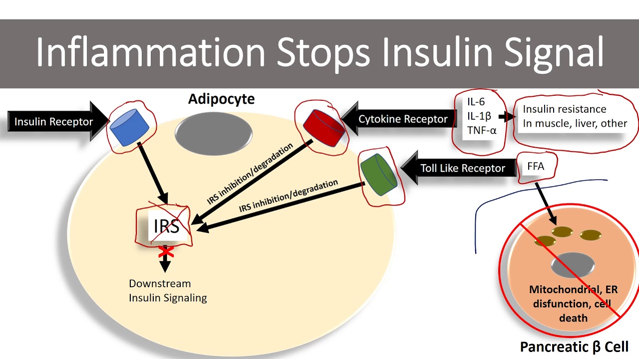 Type II Diabetes - Onset and Etiology