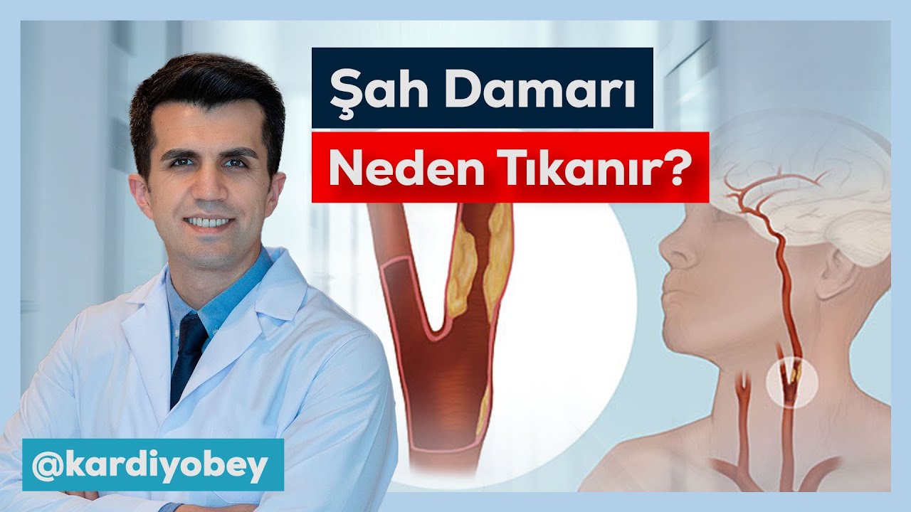 Şah Damarı (Karotis) Tıkanıklığının En Sık Sebepleri