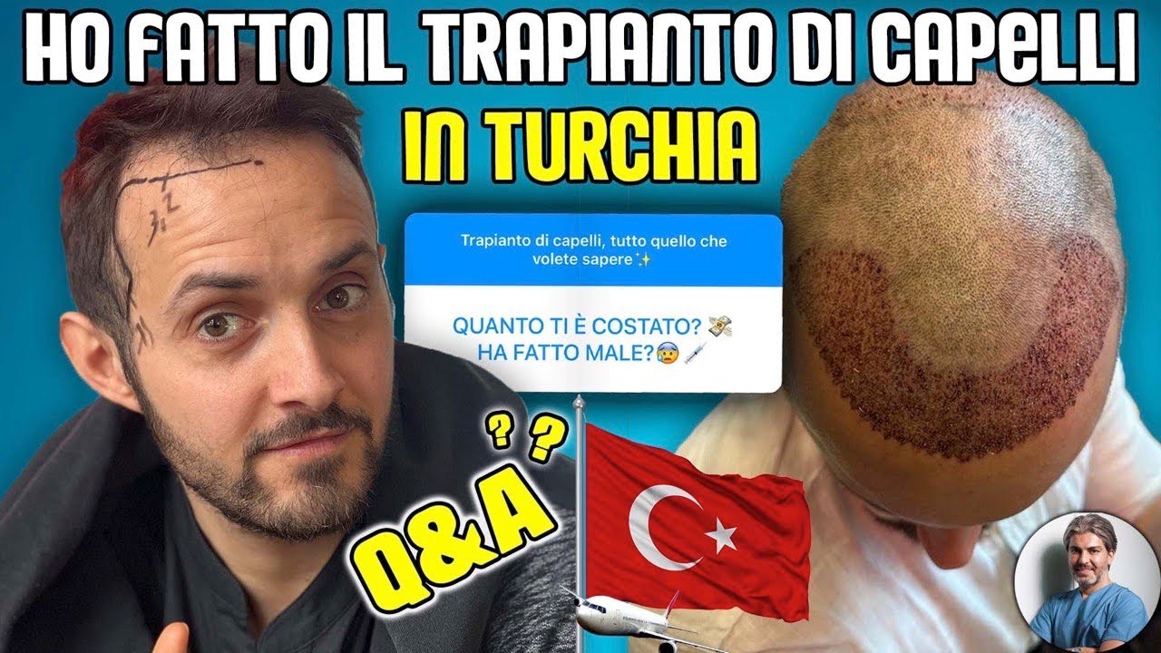 Ho fatto il trapianto di capelli in Turchia * Rispondo a TUTTE LE DOMANDE CHE MI AVETE FATTO *