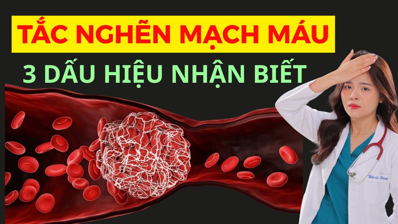 Triệu chứng TẮC NGHẼN MẠCH MÁU não | Dr Thùy Dung