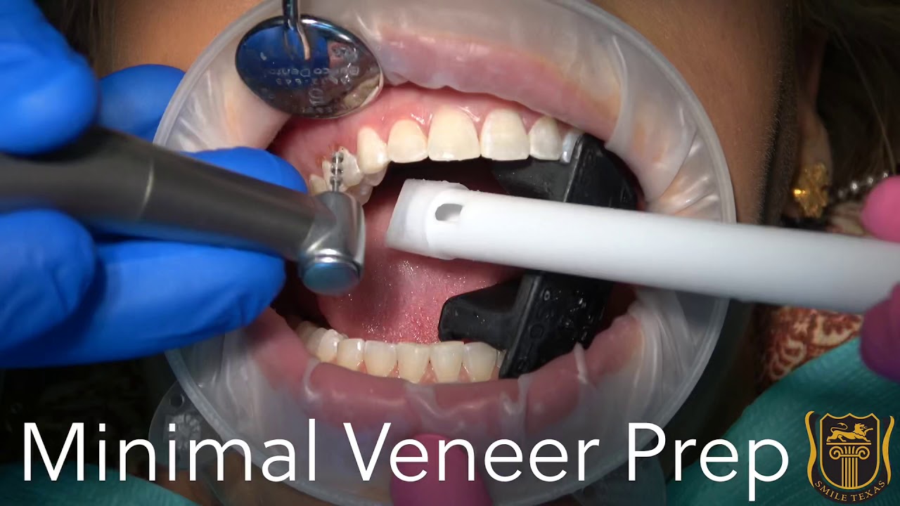 Minimal Veneer Prep by @Smiletexas
