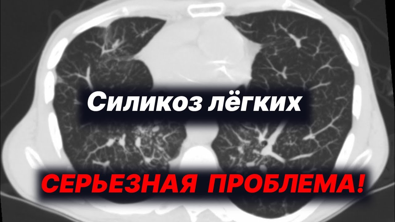 Силикоз лёгких