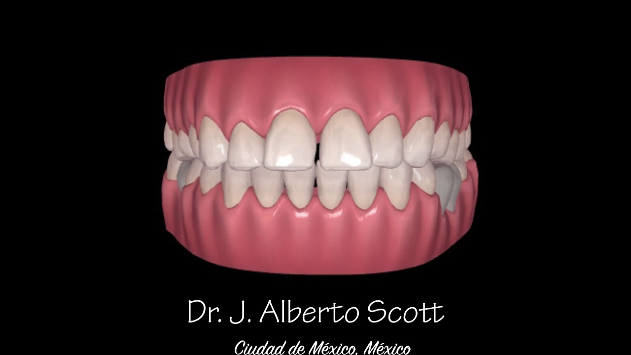 Open Bite Treatment with Invisalign. Dr. J. Alberto Scott. Orthodontist, Polanco, Mexico City