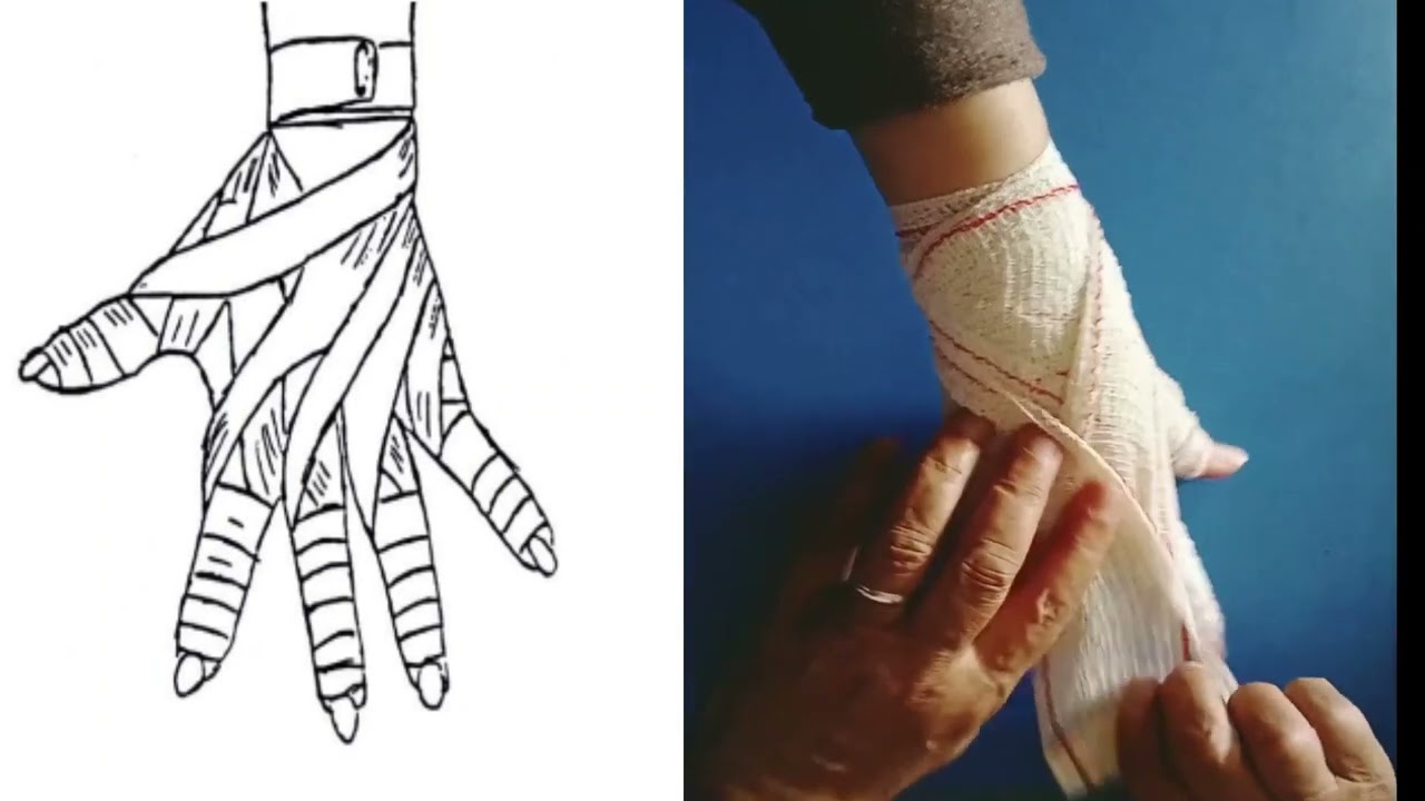 bandage des mains ; gantelet des mains ; soins infirmières